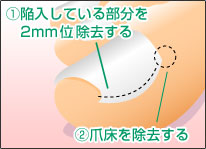 木村式巻き爪治療の図解