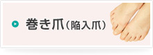 巻き爪（陥入爪）